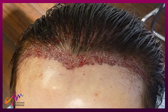 زراعة الشعر للنساء